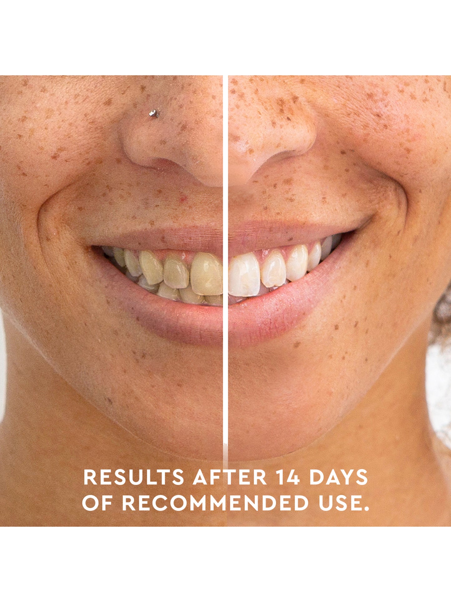 teeth whitening before and after