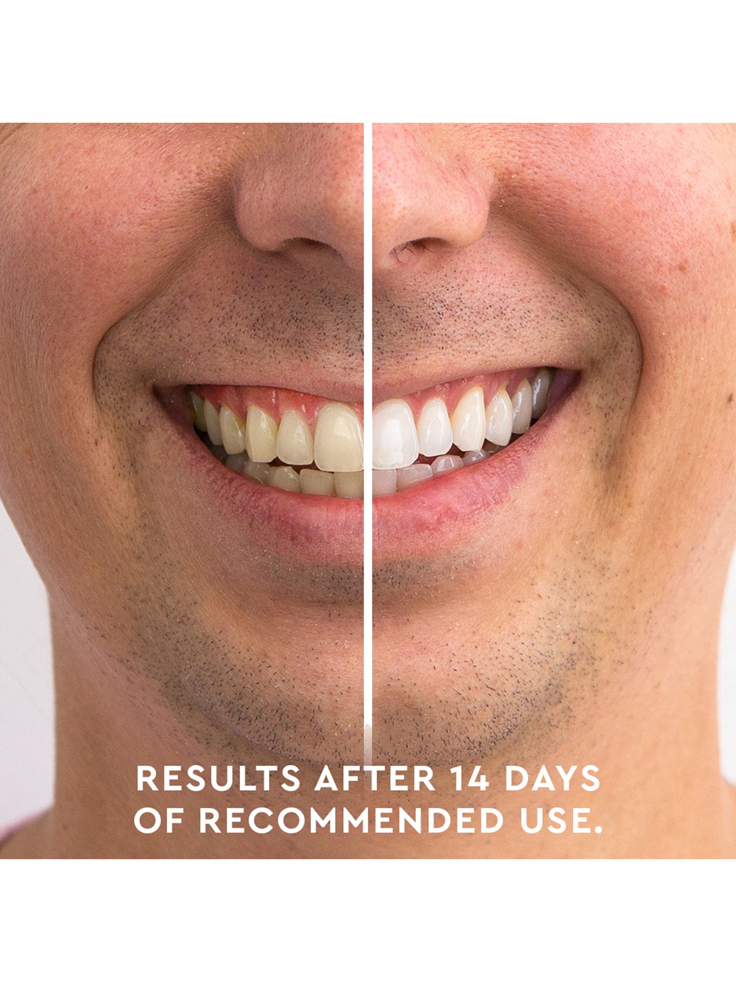 teeth whitening before and after