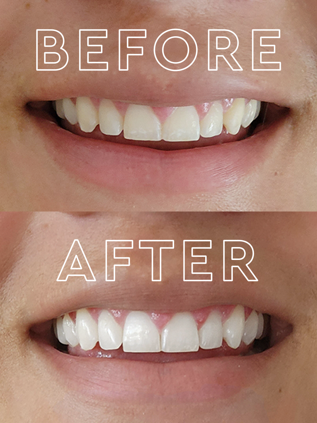 led teeth whitener before after